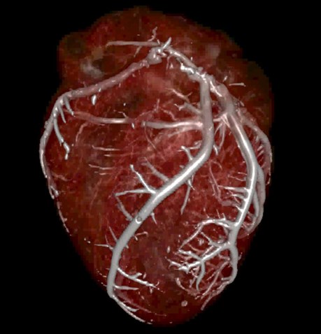 Barium Heart Barium Heart